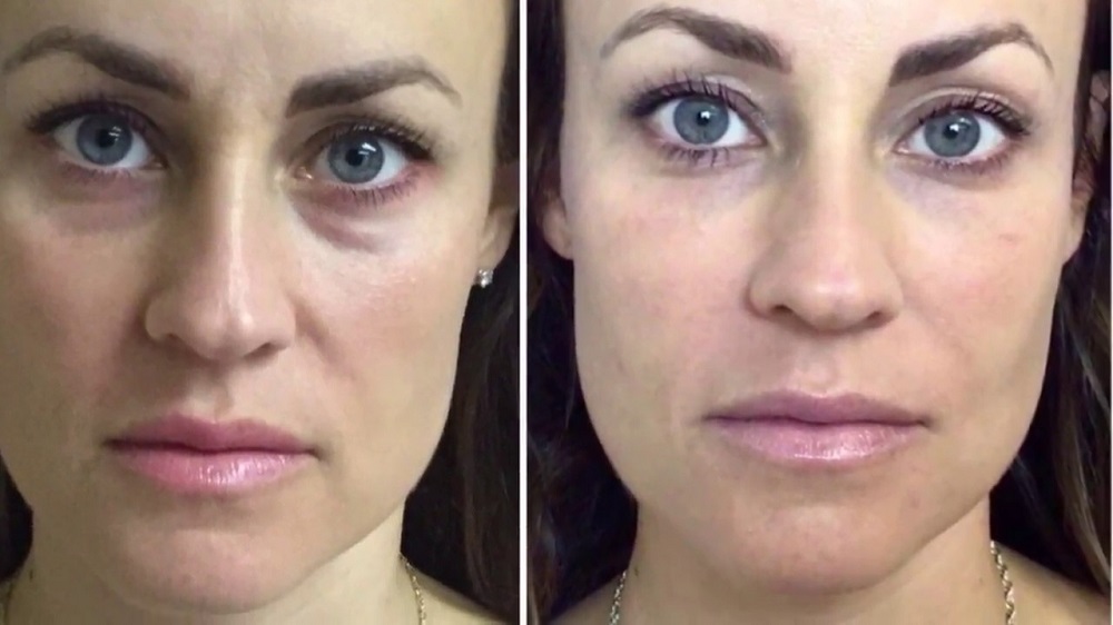 everything-you-need-to-know-about-under-eye-fillers-browser-scene