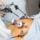 Bariatric Surgery